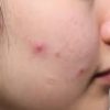 ニキビ吹き出物の3つの対策