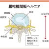 最近の腰痛事情